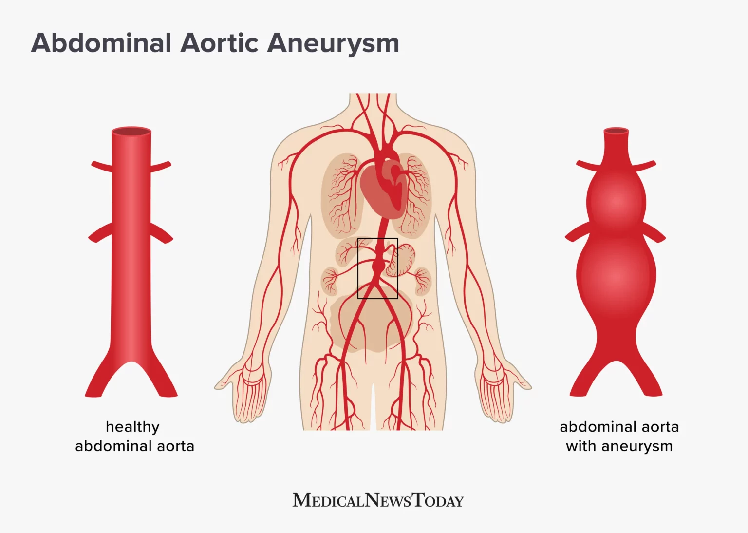 abdominal-aortic-aneurysm-scaled-1-1536x1094.webp
