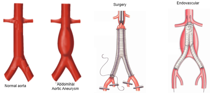aneurysm-surgery-honorhealth.png