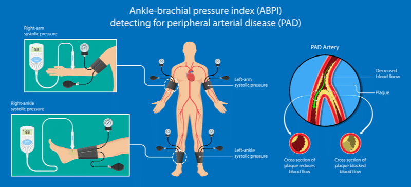 ankle-brachial-index.png