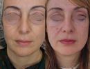 ano blepharoplastike