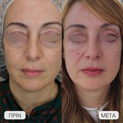 ano blepharoplastike