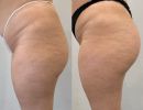 diorthose asymmetrias glouton apo yalouroniko me chrese autologou lipous3