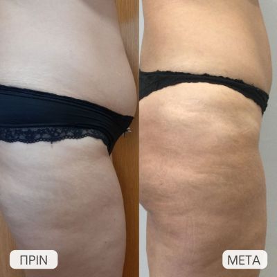 apotelesma mini koilioplastikes kai mataphora lipous stous gloutous1