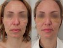 photo gallery before   after