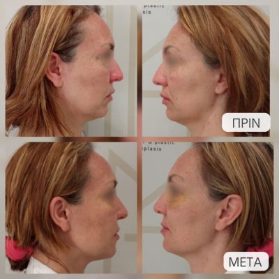 photo gallery before   after