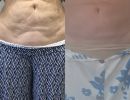 diorthose chalaroses koilias me laser minimal invasive
