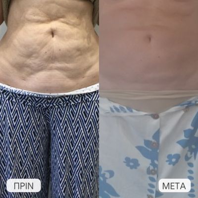 diorthose chalaroses koilias me laser minimal invasive