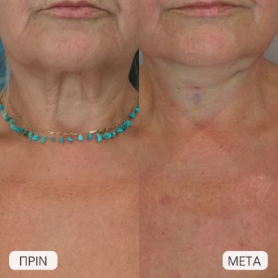 ameso apotelesma epharmoges nematon laimou1