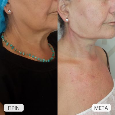 ameso apotelesma epharmoges nematon laimou2