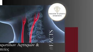 f a q aneurysma koiliakes aortes