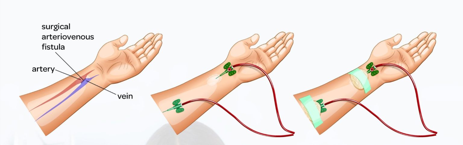 vascular_access_-_AV_fistula_-_AV_fistula_dia.width-2000-1536x483.jpg